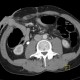 Uretherolithiasis, urolithiasis, ureteric stone, hydronephrosis, excretory phase: CT - Computed tomography